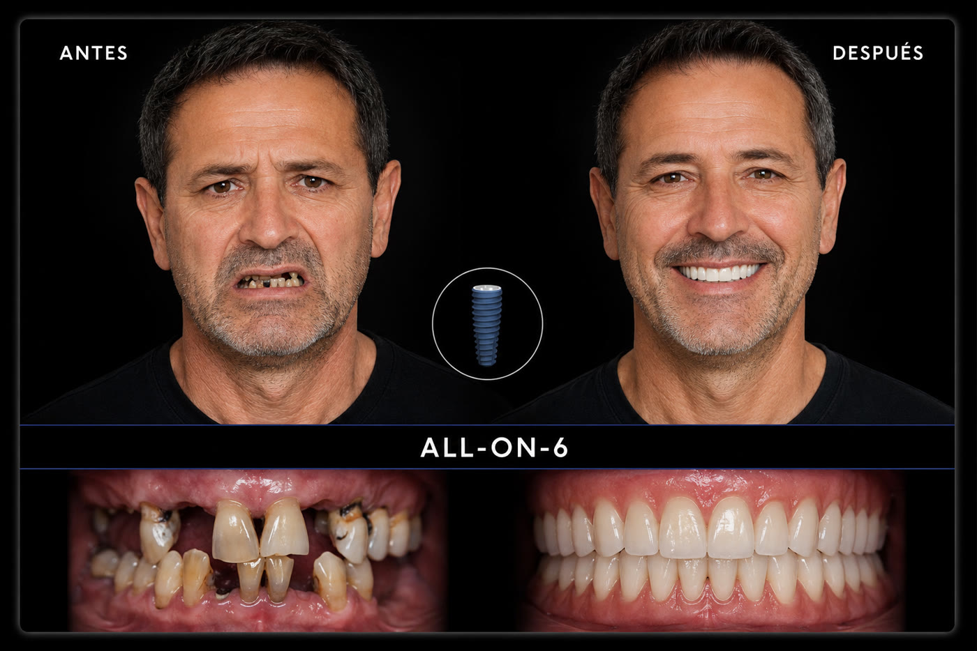 Once / Sonra - All-on-6